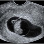 Fetal Viability Scan