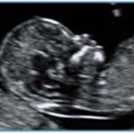 First Trimester Scan/NT Scan